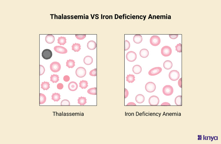 Thalassemia vs Iron Deficiency Anemia | Key Differences Explained! – Knya