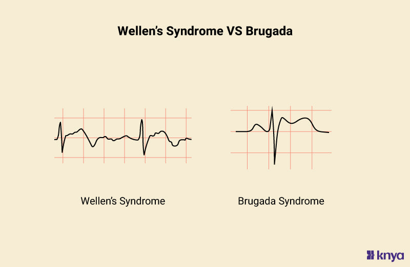 Wellens Syndrome vs Brugada Syndrome, Cardiac Diseases – Knya