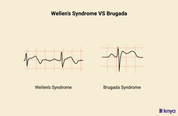 Wellens Syndrome vs Brugada Syndrome, Cardiac Diseases – Knya