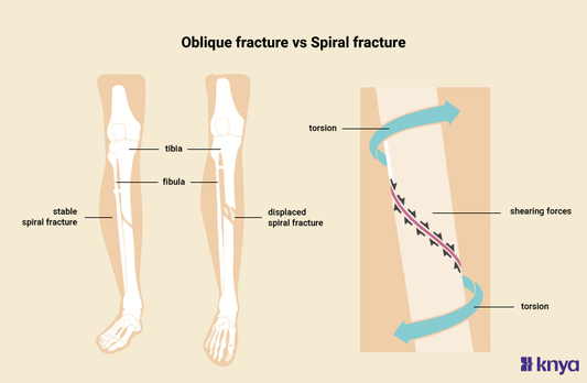 Oblique Fracture vs Spiral Fracture