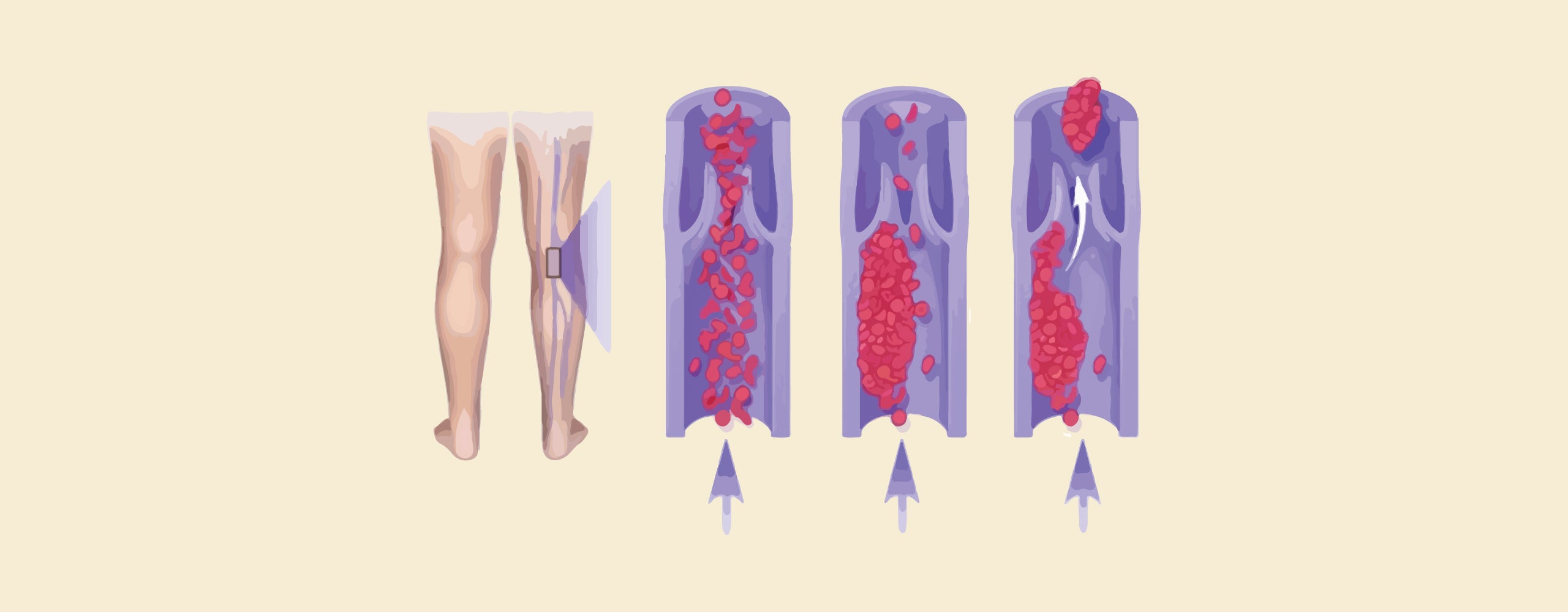 Chronic Venous Insufficiency Vs Deep Vein Thrombosis Navigating Chronic Venous Insufficiency Vs Deep Vein Thrombosis Navigating