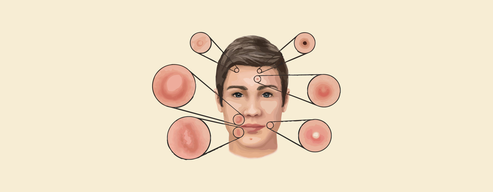 Malassezia Folliculitis and Acne: Learn their Causes and Symptoms – Knya